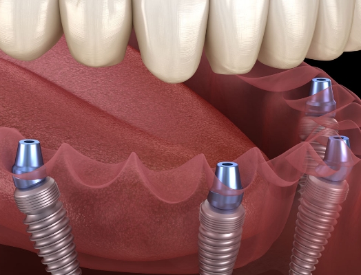 Visų dantų implantacija